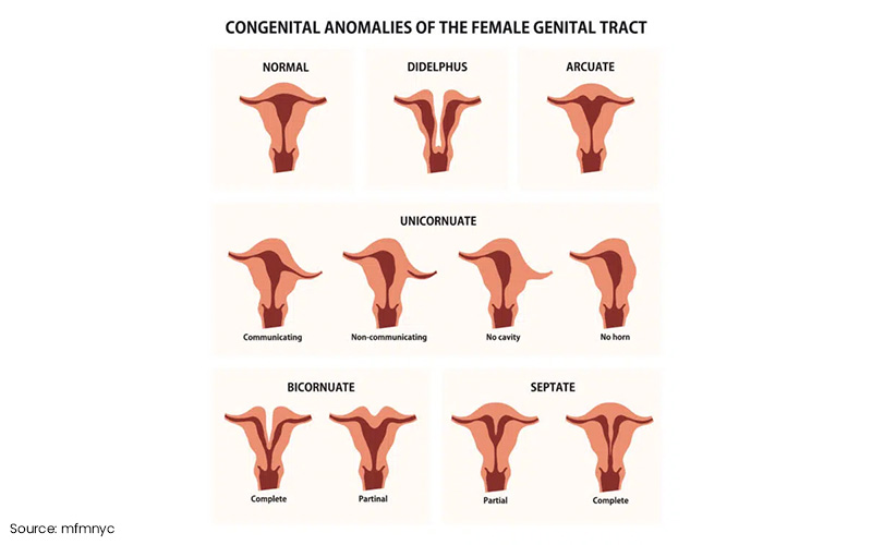 Understanding Uterine Abnormalities